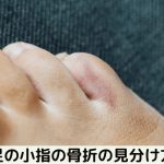 足の小指の骨折の見分け方